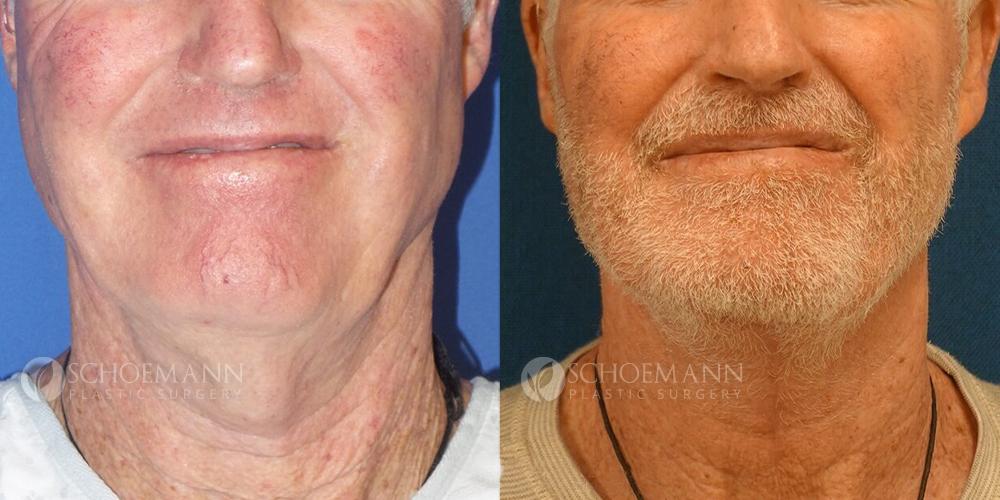 Schoemann-Plastic-Surgery_Encinitas_neck-lift-patient-1-1