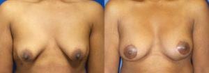 Schoemann-Plastic-Surgery_Encinitas_Breast-Lift-patient-1-1