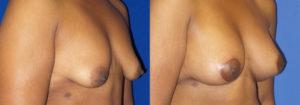 Schoemann-Plastic-Surgery_Encinitas_Breast-Lift-patient-1-2