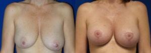 Schoemann-Plastic-Surgery_Encinitas_Breast-Lift-patient-2-1
