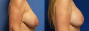 Schoemann-Plastic-Surgery_Encinitas_Breast-Lift-patient-3-3