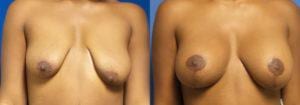 Schoemann-Plastic-Surgery_Encinitas_Breast-Lift-patient-5-1