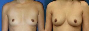 Schoemann-Plastic-Surgery_Encinitas_breast-augmentation-patient-11-3