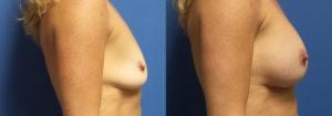 Schoemann-Plastic-Surgery_Encinitas_breast-augmentation-patient-5-3