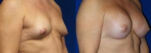 Schoemann-Plastic-Surgery_Encinitas_breast-augmentation-patient-9-2