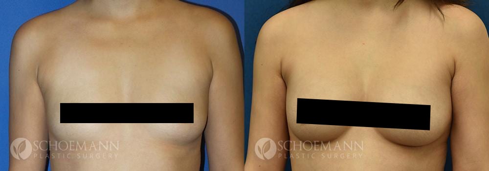 Schoemann-Plastic-Surgery_Encinitas_breast-augmentation_censored__0001_2