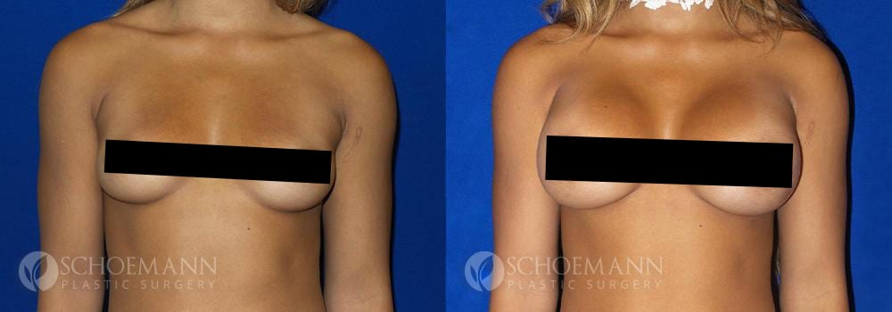 Schoemann-Plastic-Surgery_Encinitas_breast-augmentation_censored__0003_4
