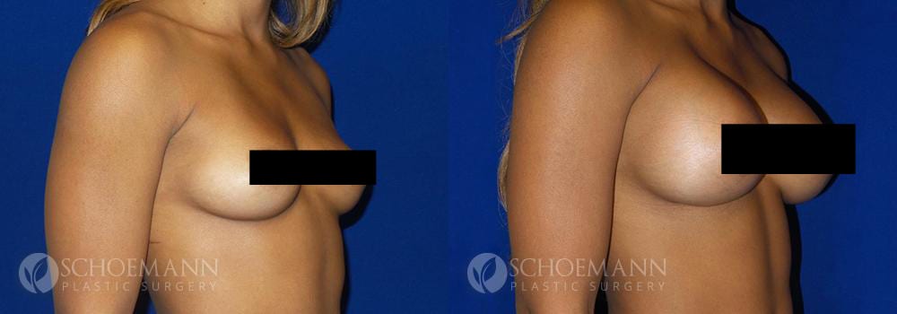 Schoemann-Plastic-Surgery_Encinitas_breast-augmentation_censored__0004_5