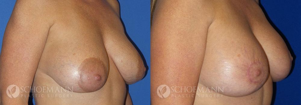 Schoemann-Plastic-Surgery_Encinitas_breast-revision-patient-1-2