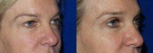 Schoemann-Plastic-Surgery_Encinitas_eyelid-surgery-patient-1-2