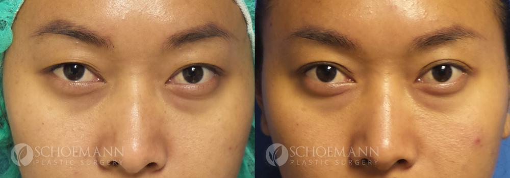 Schoemann-Plastic-Surgery_Encinitas_eyelid-surgery-patient-2-1