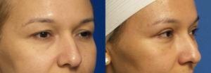 Schoemann-Plastic-Surgery_Encinitas_eyelid-surgery-patient-2-3