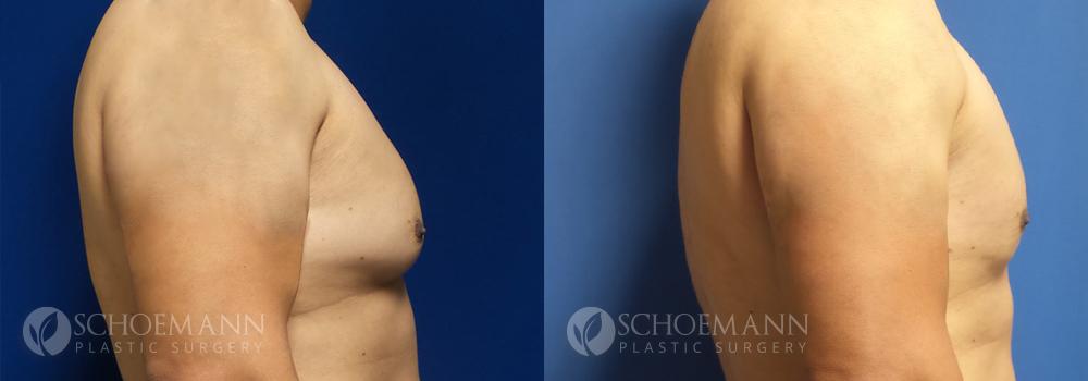Schoemann-Plastic-Surgery_Encinitas_gynecomastia-patient-1-3