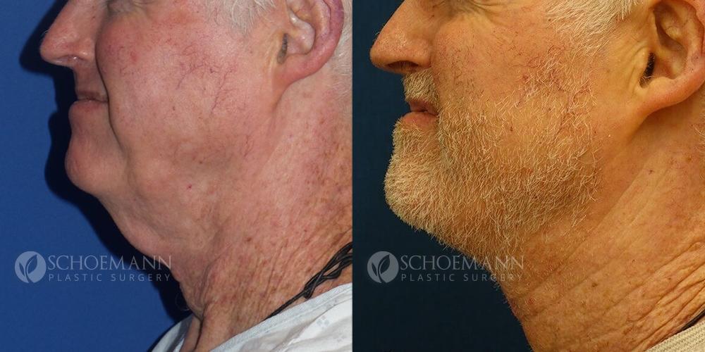 Schoemann-Plastic-Surgery_Encinitas_neck-lift-patient-1-2