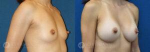 breast augmentation patient 12-3a
