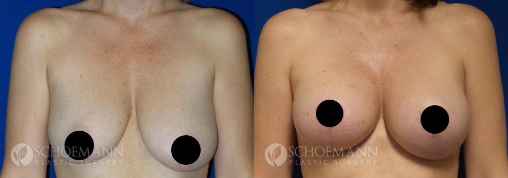 schoemann-plastic-surgery-encinitas-breast-augmentation-breast-lift-patient-2-1-censored