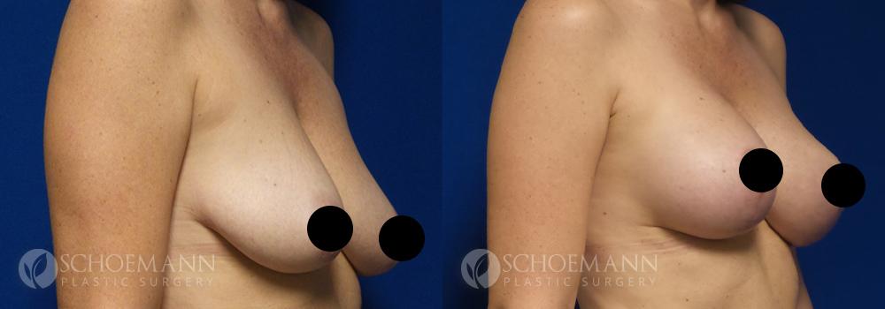 schoemann-plastic-surgery-encinitas-breast-augmentation-breast-lift-patient-2-2-censored