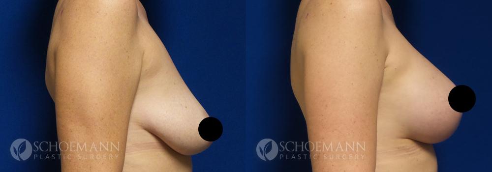 schoemann-plastic-surgery-encinitas-breast-augmentation-breast-lift-patient-2-3-censored