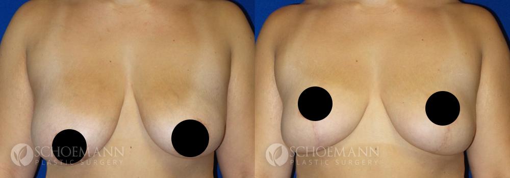 schoemann-plastic-surgery-encinitas-breast-augmentation-breast-lift-patient-4-1-censored