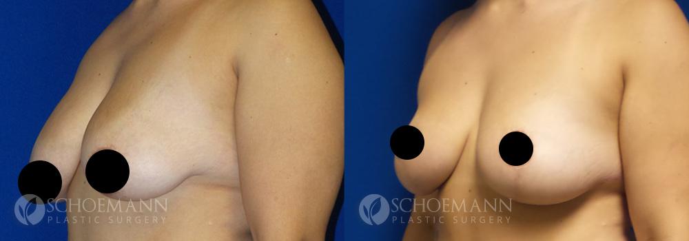 schoemann-plastic-surgery-encinitas-breast-augmentation-breast-lift-patient-4-2-censored