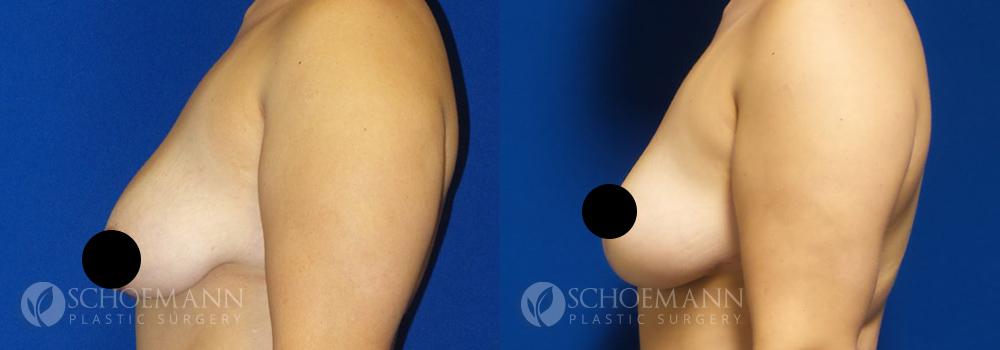 schoemann-plastic-surgery-encinitas-breast-augmentation-breast-lift-patient-4-3-censored