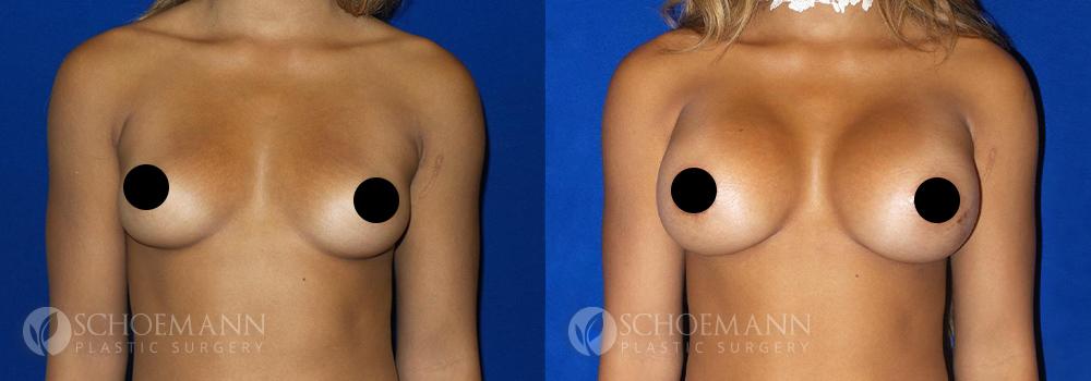 schoemann-plastic-surgery-encinitas-breast-augmentation-patient-1-1-censored