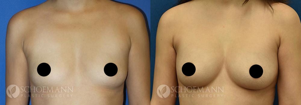 schoemann-plastic-surgery-encinitas-breast-augmentation-patient-11-1-censored
