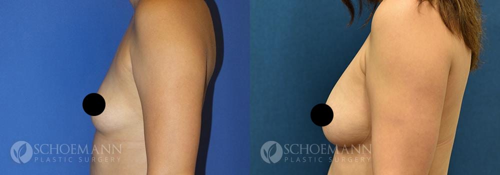 schoemann-plastic-surgery-encinitas-breast-augmentation-patient-11-3-censored