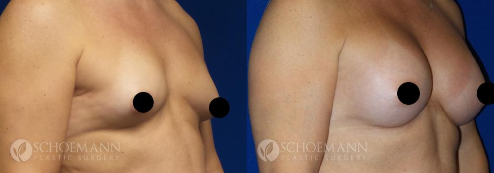 schoemann-plastic-surgery-encinitas-breast-augmentation-patient-9-2-censored