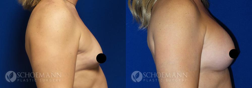schoemann-plastic-surgery-encinitas-breast-augmentation-patient-9-3-censored